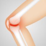 Arthrose